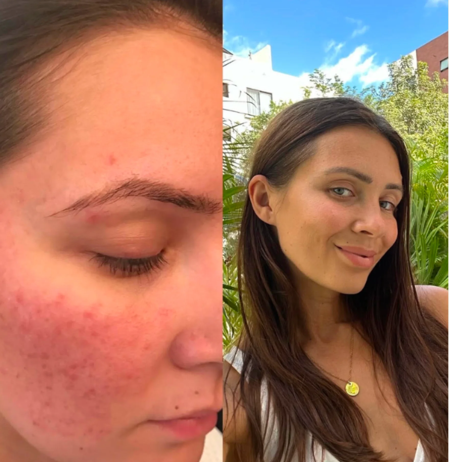 Zelata before and after: rosacea on her cheek, then clear skin